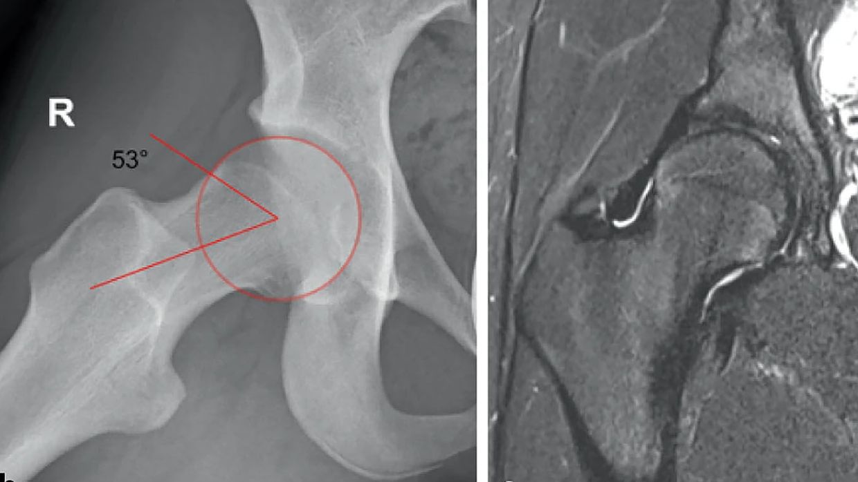 Femoroacetabuläres Impingement-Syndrom Bei Jugendlichen - Orthopädie ...